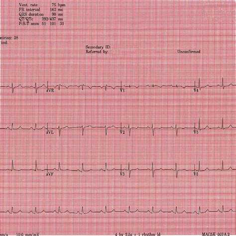 Twelve Lead Electrocardiogram Showing Sinus Rhythm With An Incomplete