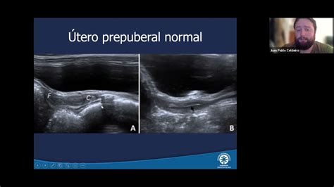 Webinar Pediatría Ecografía Ginecológica Pediátrica Youtube