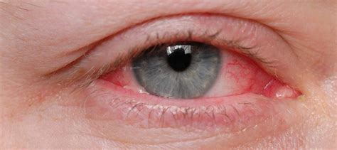 What Natural Treatments for Pink Eye Work? | Healthy Directions