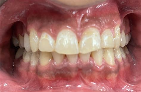 White Spot Lesions Creating Beautiful Smiles