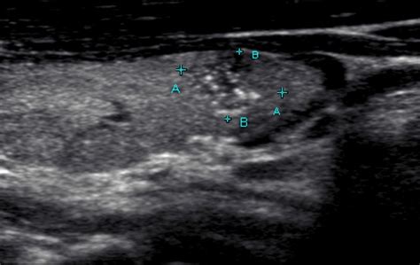 To Biopsy Or Not The Thyroid Nodule Dilemna Dr Iain Duncan