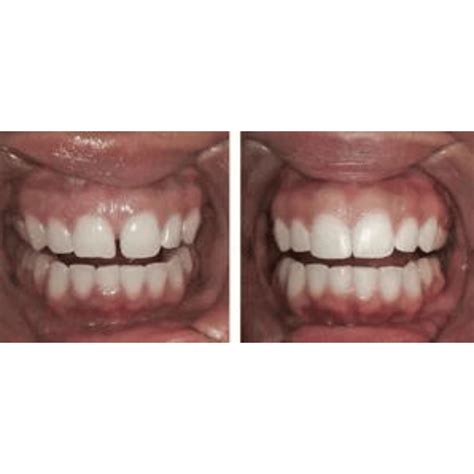 Dental Bonding Cost Affordable Options For Your Smile Makeover Smile