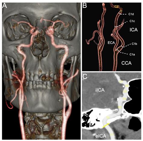 Medicina Free Full Text Morphometry Of The Entire Internal Carotid Artery On Ct Angiography