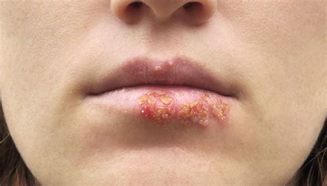 Herpes Labial Contagio S Ntomas Y Tratamiento Md Sa De