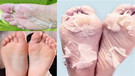 How To Get Rid Of Peeling Skin On Your Feet Youtube