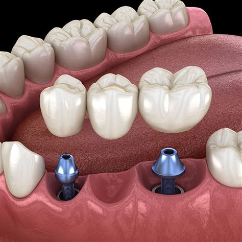 Dental Implants Henderson Nv Implant Dentistry Carepoint Dental