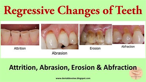 Abrasion Diagram