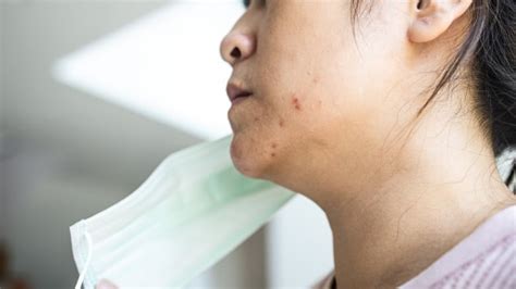 Red Bumps Or Rash From Wearing A Mask Here Are Some Tips To Prevent Acne Cbc News