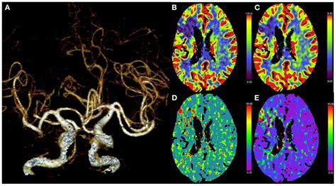 Frontiers Mechanical Thrombectomy For Acute Multivessel Occlusions