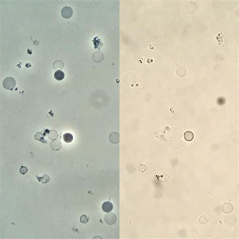 Erythrocytes With Different Hemoglobin Contents From Normal To None