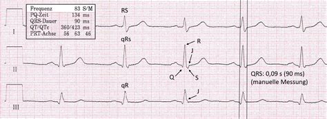 QRS Komplex Fokus EKG