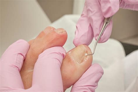 Top Tips Ingrown Toenail Treatment S Causes And Precautions