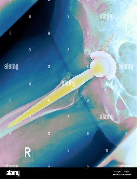 Total Hip Replacement Coloured Frontal X Ray Of The Right Leg And