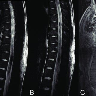 MRI Of Thoracic Spine A B Sagittal T2 Weighted Images Showing