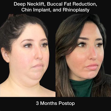 Buccal Fat Removal St Louis Mo Nayak Plastic Surgery