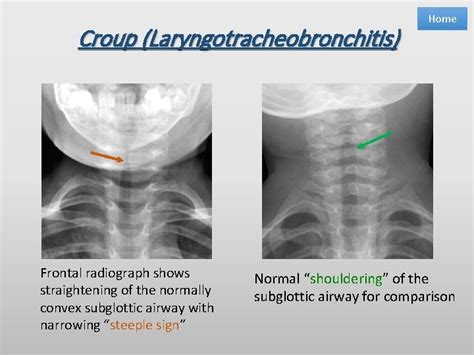 Imaging Of Pediatric Head And Neck Emergencies Adam