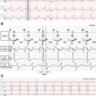 A A 12 Lead ECG After Ablation The Underlying Rhythm Is Sinus Rhythm