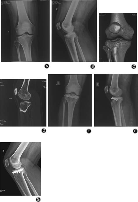 Anteromedial Anterolateral Tibial Plateau Fracture Male 33 Years Download Scientific