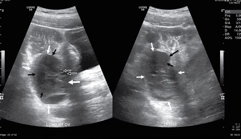 Ovarian Torsion Core Em