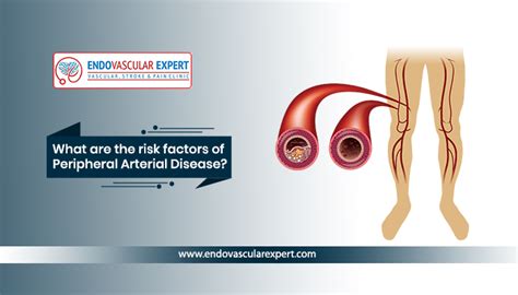 Risk Factors Of Peripheral Arterial Disease Dr Nikhil Bansal