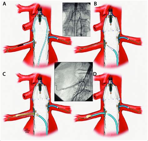 Sheath Advancement Using The Top Part Of The Fenestrated Stent A B Download Scientific