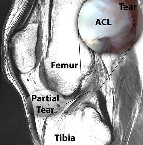 Biologic Approaches For The Treatment Of Partial Tears Of The Anterior