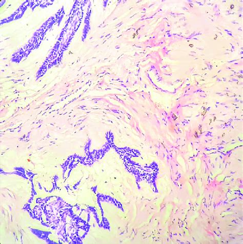 Moderately Collagenous Connective Tissue Stroma With Few Chronic