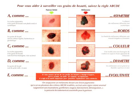 Les grains de beauté comment les surveiller kineosteosport