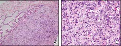 Pdf Primary Apocrine Adenocarcinoma Of The Axilla Semantic Scholar