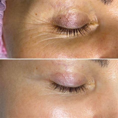 Non Surgical Blepharoplasty Madonna Eye Lift Aetherclinic