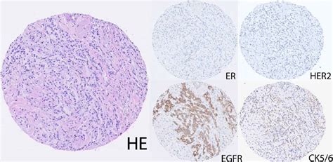 Immunohistochemical Staining Of A Representative Basal Like Breast