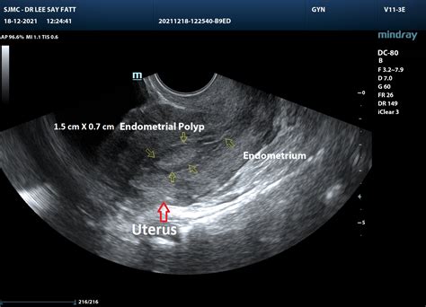 Endometrial Polyps Womens Health By Dr Lee Say Fatt