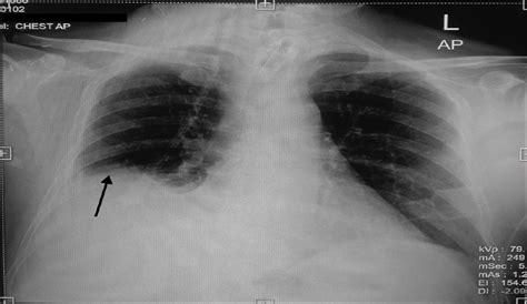 weaning failure due  postoperative phrenic nerve palsy  indian