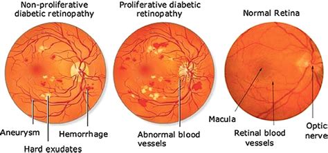 Comparative Analysis Of Detection And Classification Of Diabetic