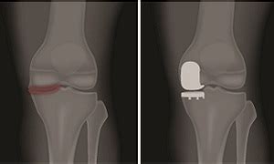 Partial Knee Replacement Procedure