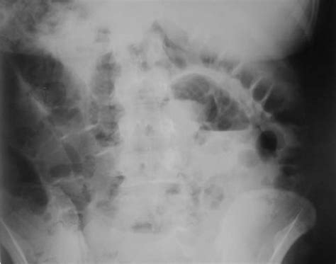 Plain Abdominal Radiography Air Fluid Level Is Observed Download Scientific Diagram