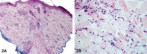 An Elderly Woman With Painful Annular Erythematous Plaques Journal Of The American Academy Of