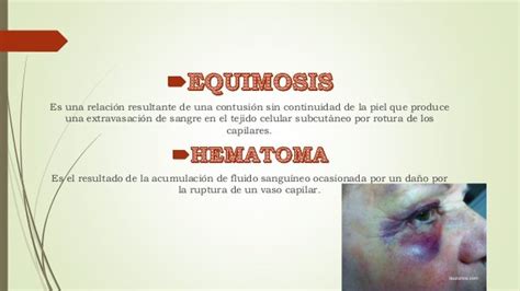 Equimosis Y Hematomas