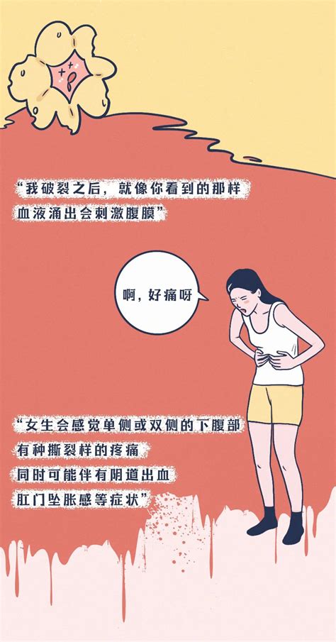 黄体破裂的1个重要表现，请全体女性牢记澎湃号·湃客澎湃新闻 The Paper