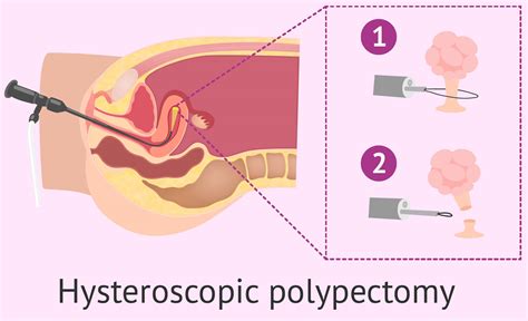 Polypectomy Definition Colonoscopic Endometrial Nasal And Cervical