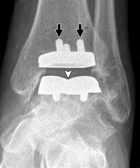 Current Concepts In Total Ankle Replacement For Radiologists Features