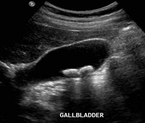 Gallbladder Ultrasound Gallstones