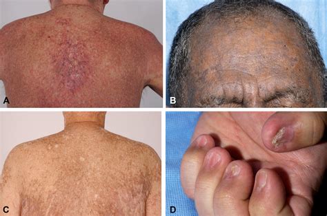 Chronic Graft Versus Host Disease Part I Epidemiology Pathogenesis