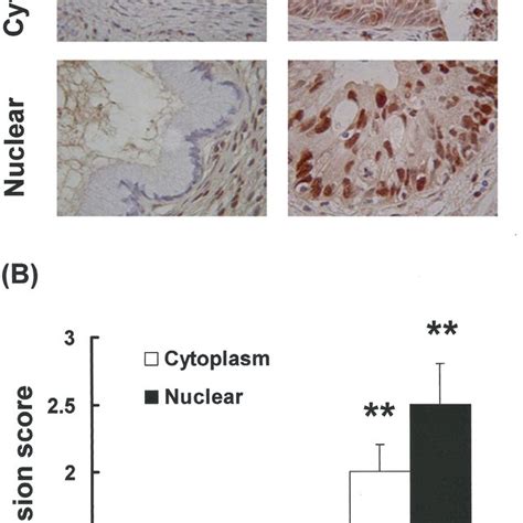 Differential Nuclear And Cytoplasm Hepatoma Derived Growth Factor