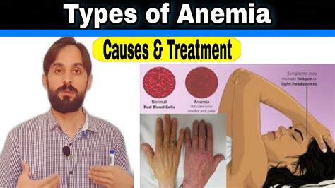 Types Of Anemia Causes And Treatment Youtube