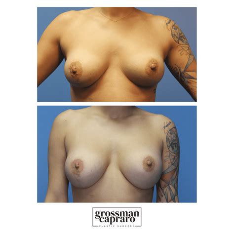 Breast Lift With Implants Grossman Capraro Plastic Surgery