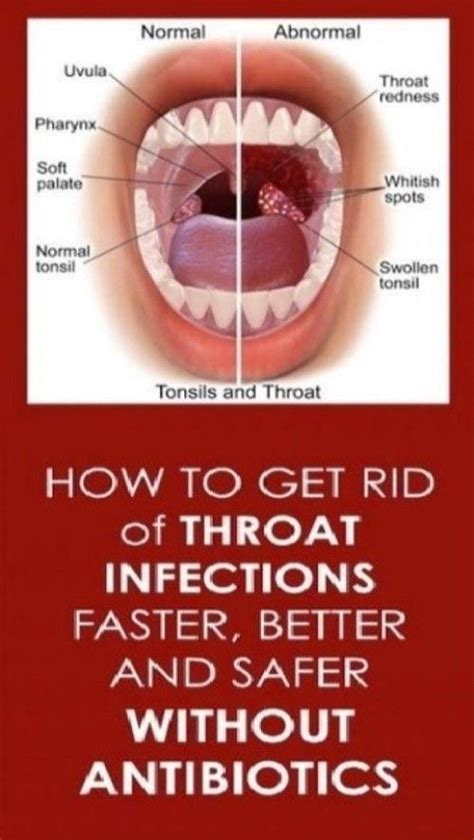 Is Strep Throat Contagious After You Start Taking Antibiotics