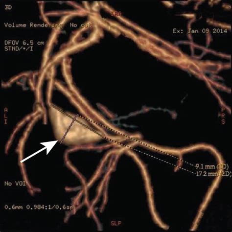 Photograph Of Aneurysm A Group A Fusiform Aneurysm B Group B Download Scientific Diagram