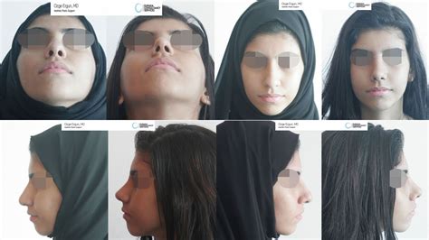 Rhinoplasty Before After 10 Days Result Ozge Ergun MD Aesthetic