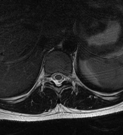 Normal Thoracic Spine Mri